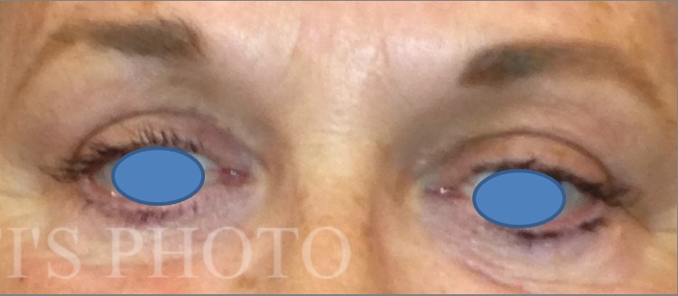 Blepharoplasty before and after - after