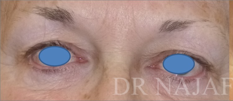 Blepharoplasty before and after - before