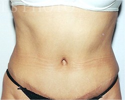 Tummy Tuck before and after - after