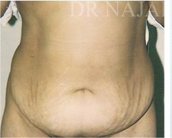 Tummy Tuck before and after - before