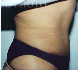Tummy Tuck before and after - after