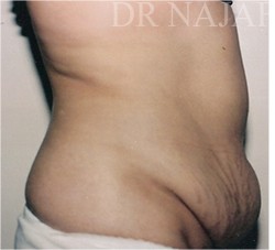 Tummy Tuck before and after - before