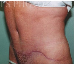 Tummy Tuck before and after - after