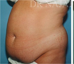 Tummy Tuck before and after - before