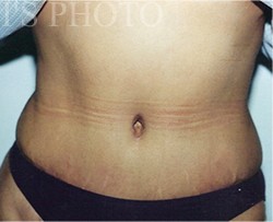 Tummy Tuck before and after - after
