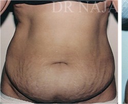 Tummy Tuck before and after - before