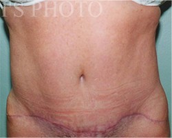 Tummy Tuck before and after - after