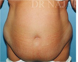 Tummy Tuck before and after - before
