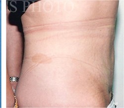 Tummy Tuck before and after - after