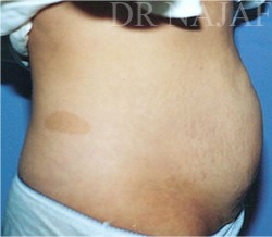 Tummy Tuck before and after - before