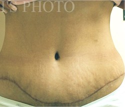 Tummy Tuck before and after - after
