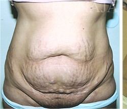 Tummy Tuck before and after - before