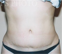Tummy Tuck before and after - after