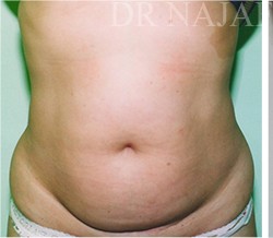Tummy Tuck before and after - before