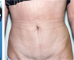 Tummy Tuck before and after - after