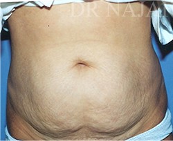 Tummy Tuck before and after - before
