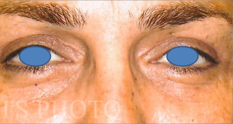 Blepharoplasty before and after - after