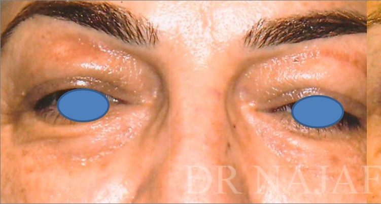 Blepharoplasty before and after - before