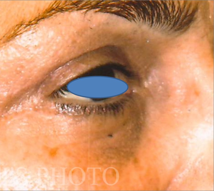Blepharoplasty before and after - after