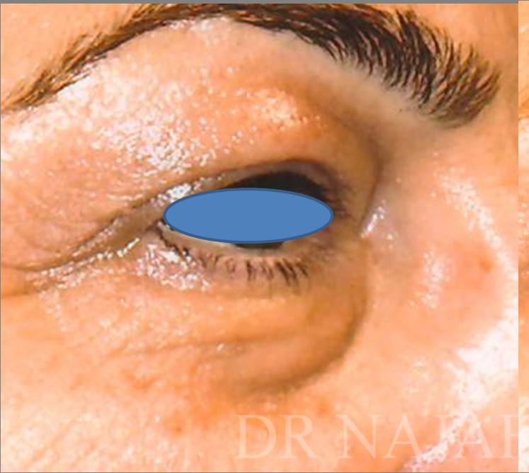 Blepharoplasty before and after - before