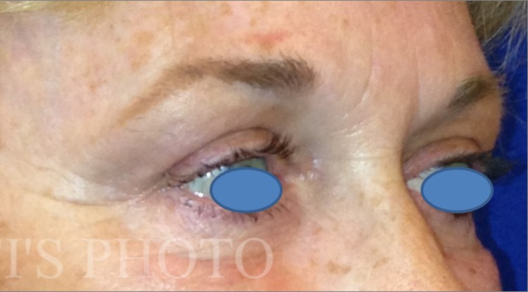 Blepharoplasty before and after - after