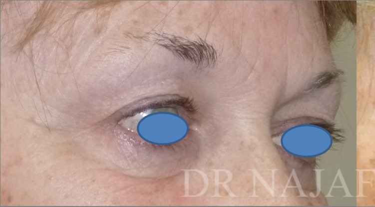 Blepharoplasty before and after - before