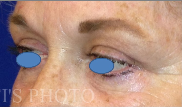 Blepharoplasty before and after - after