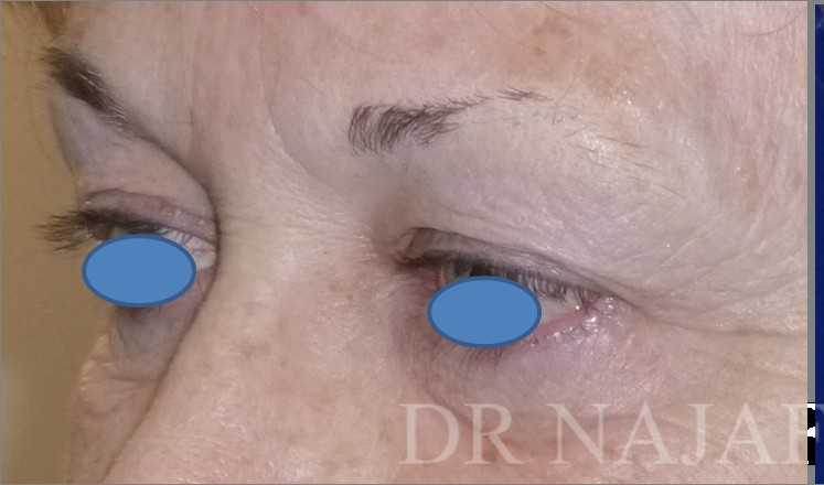 Blepharoplasty before and after - before