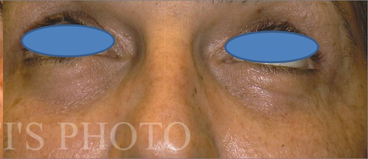 Blepharoplasty before and after - after