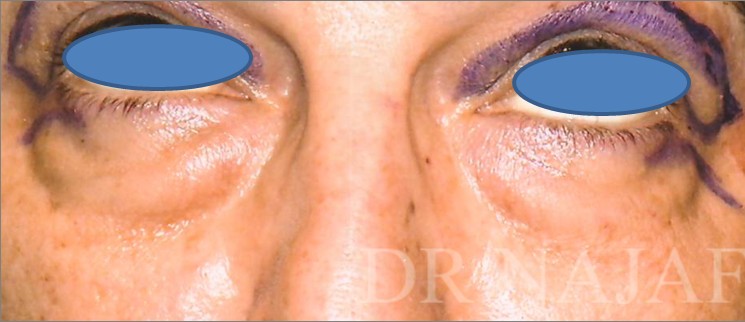 Blepharoplasty before and after - before