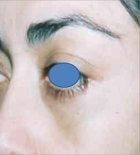 Blepharoplasty before and after - after