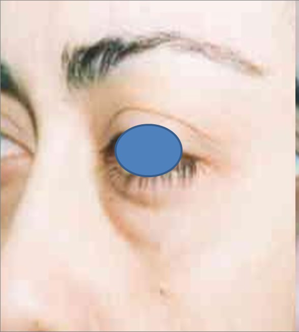 Blepharoplasty before and after - before