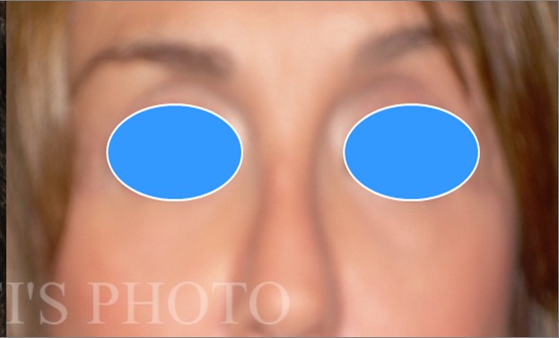 Blepharoplasty before and after - after