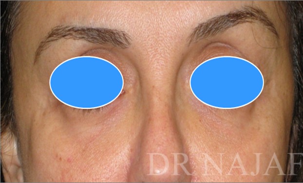 Blepharoplasty before and after - before
