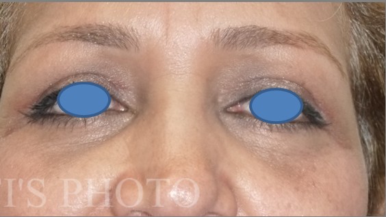 Blepharoplasty before and after - after