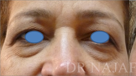 Blepharoplasty before and after - before