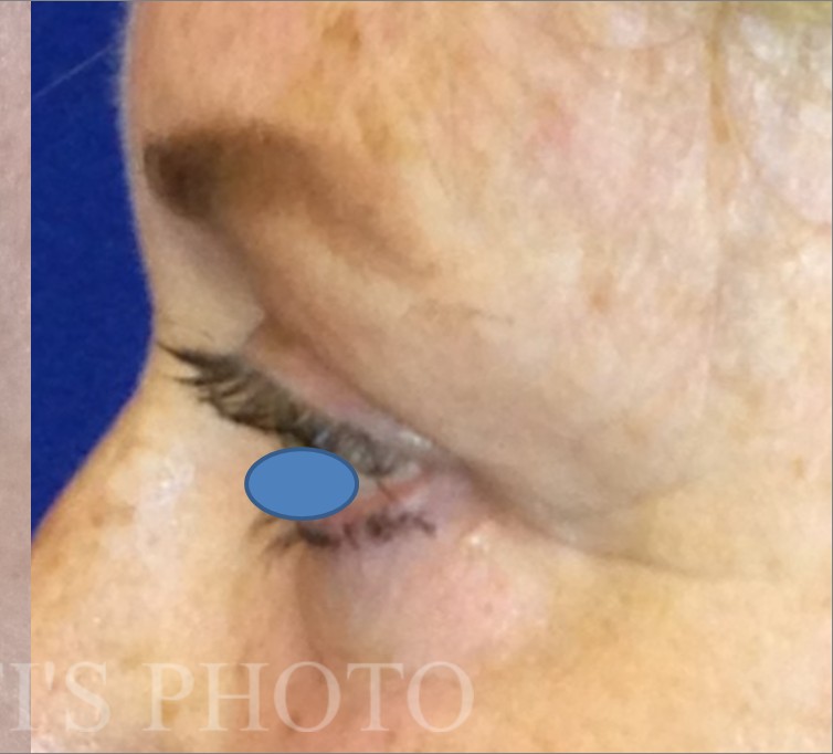 Blepharoplasty before and after - after