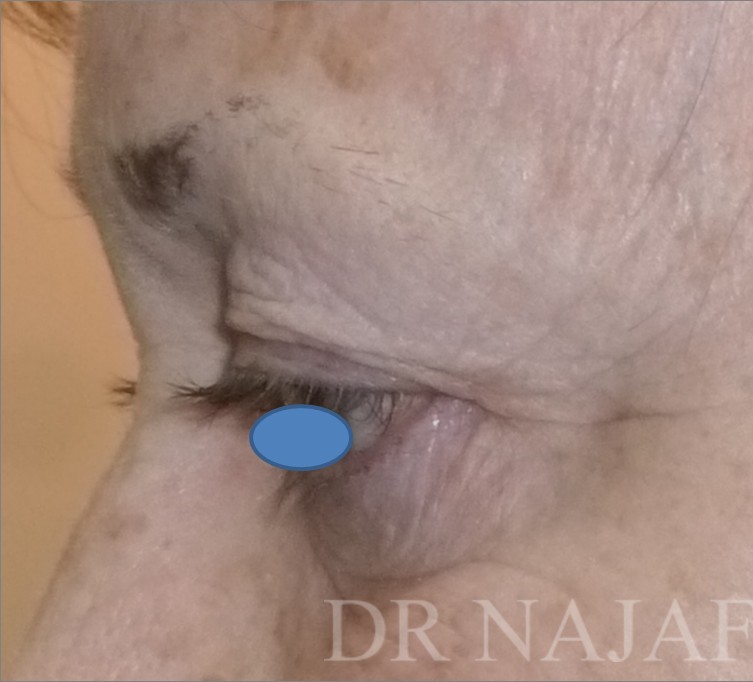 Blepharoplasty before and after - before