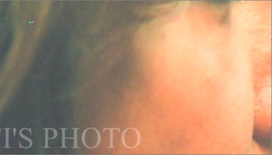 Blepharoplasty before and after - after