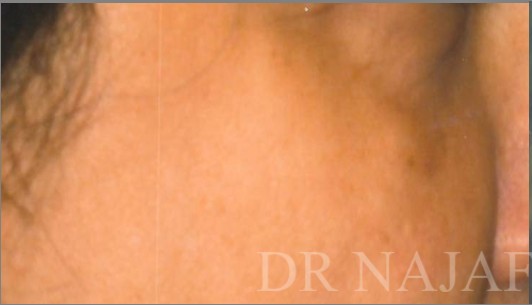 Blepharoplasty before and after - before