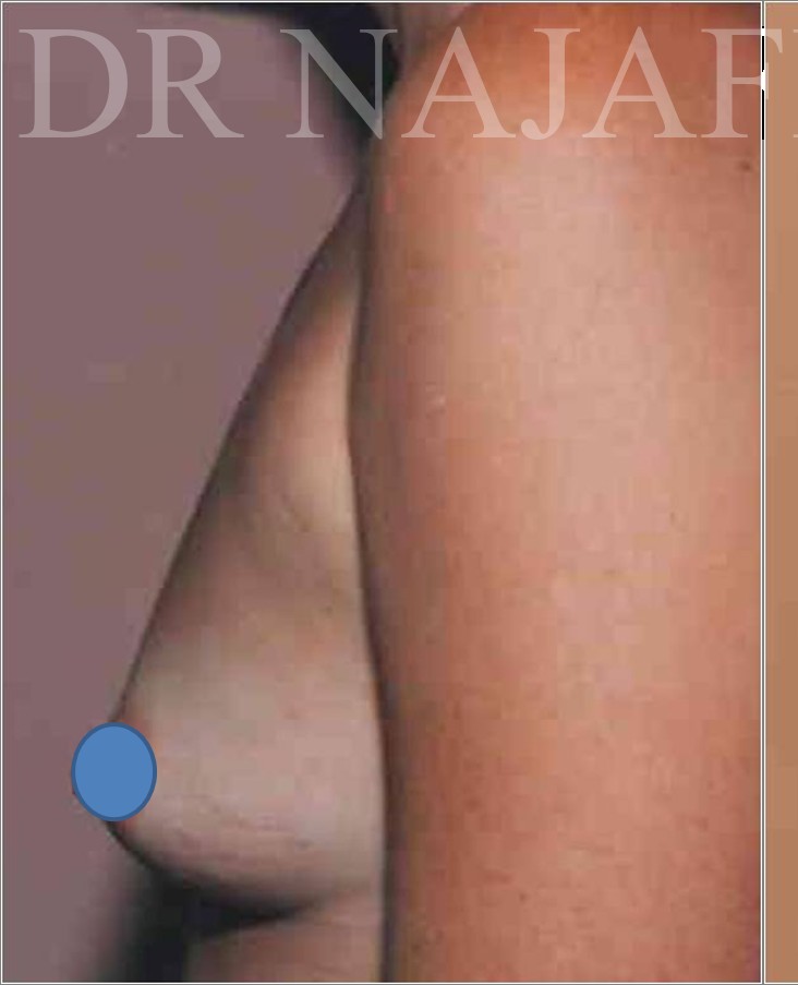 Breast Augmentation before and after - before