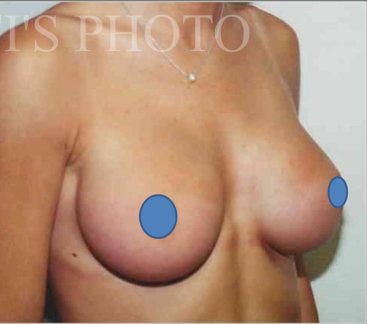 Breast Augmentation before and after - after