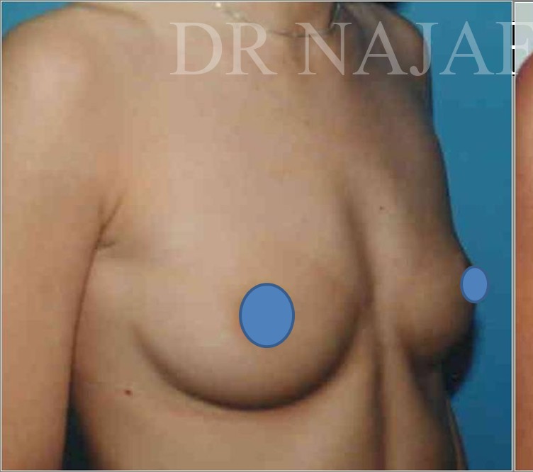 Breast Augmentation before and after - before