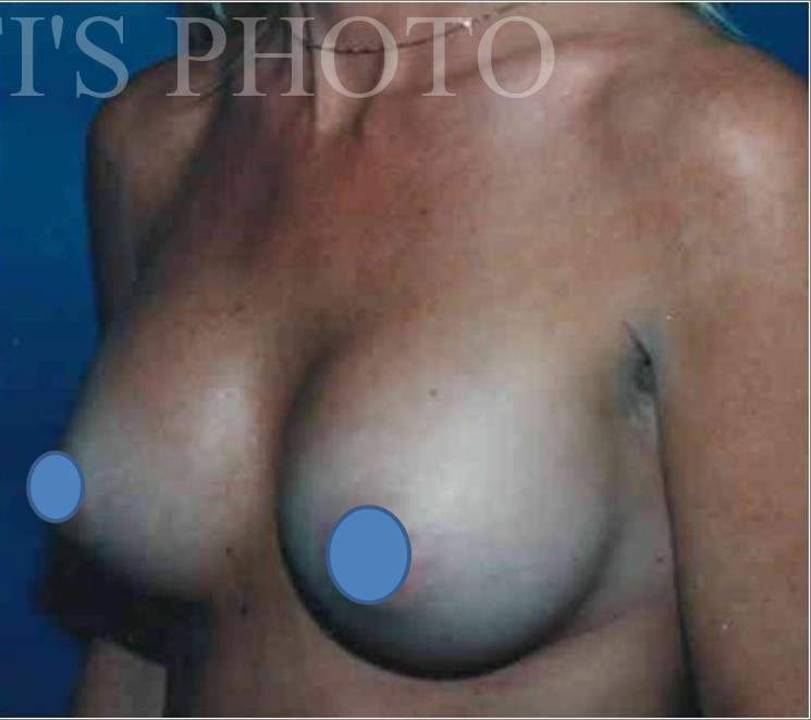 Breast Augmentation before and after - after