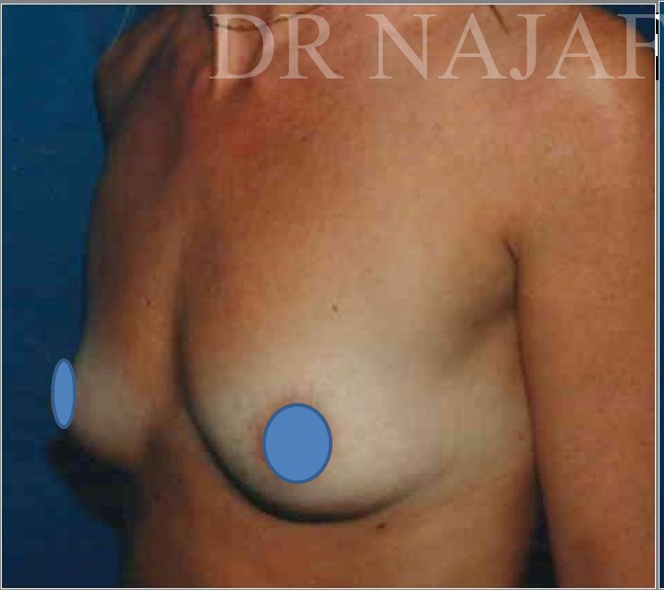 Breast Augmentation before and after - before