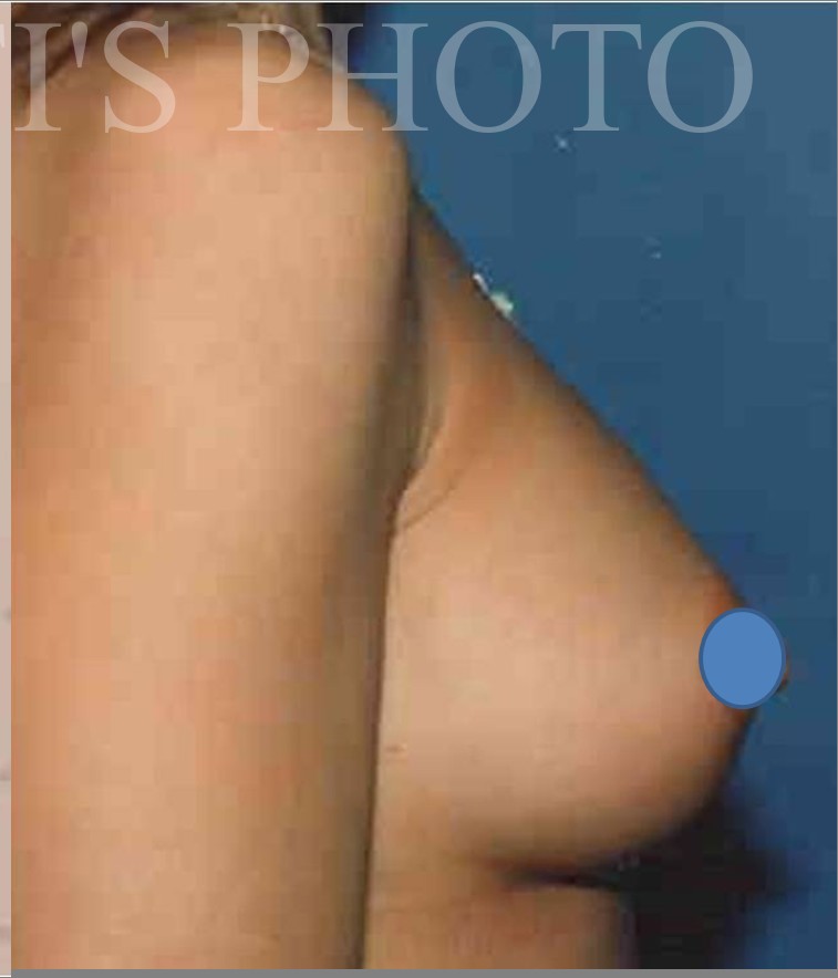 Breast Augmentation before and after - after