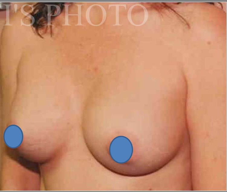 Breast Augmentation before and after - after