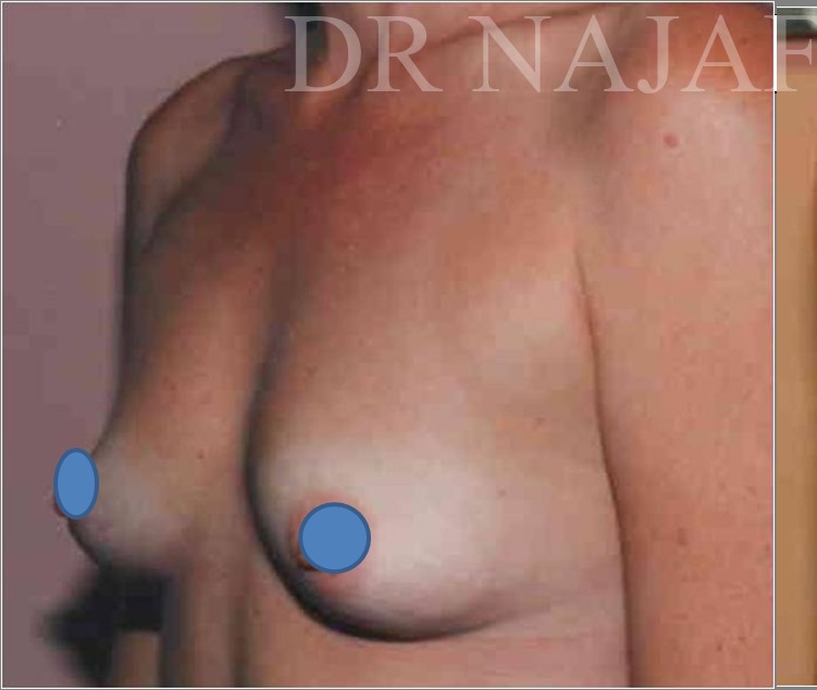 Breast Augmentation before and after - before