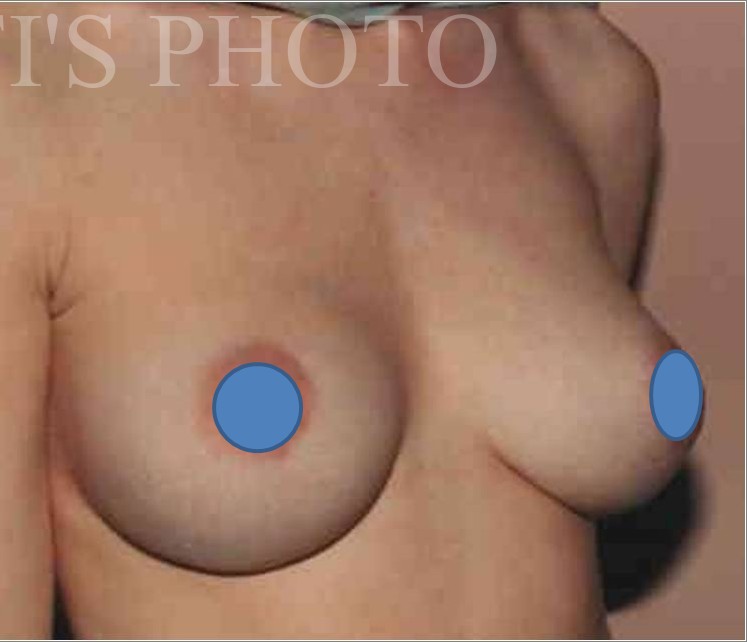 Breast Augmentation before and after - after