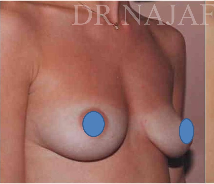 Breast Augmentation before and after - before